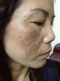 Nám da gây ảnh hưởng nghiêm trọng tới vẻ ngoài của chị em phụ nữ